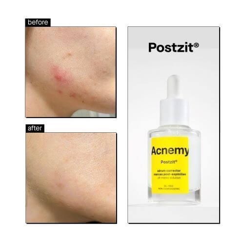 Сироватка від висипань Acnemy Postzit 9003 фото